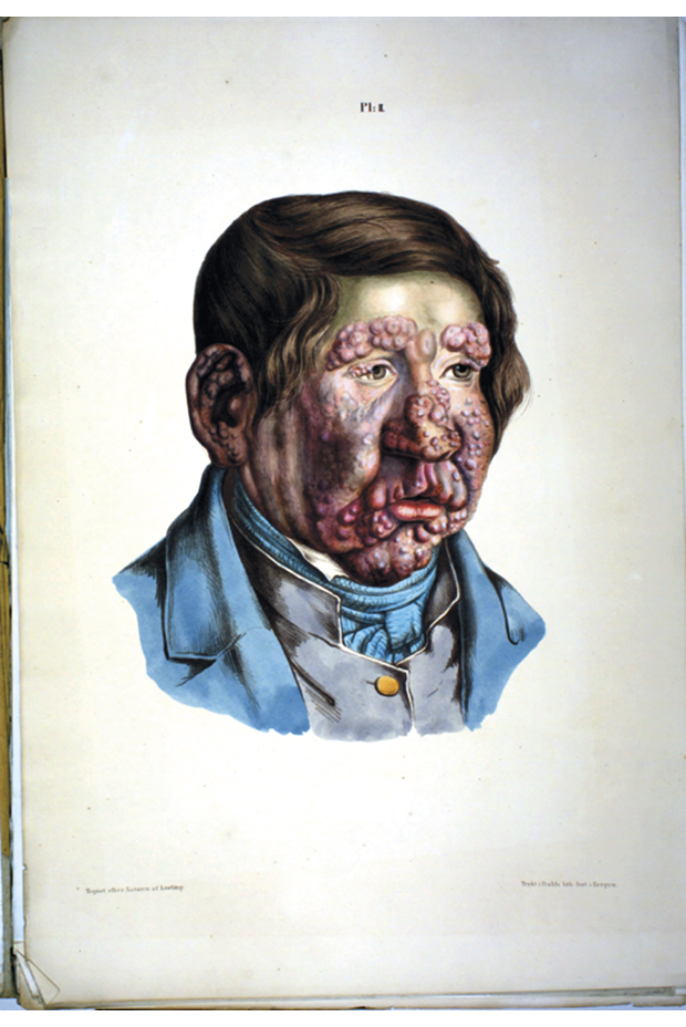 Figur 3.3 Illustrasjon frå J.L. Lostings lepraatlas. En 13 Aar gammel Dreng, hos hvem Knuderne ere fuldkommen udviklede, de ere confluerede paa flere Steder, og mange have begyndt at ramollere. Öienbrynere ere affaldne. Han blev Spedalsk i sit 6te Aar.