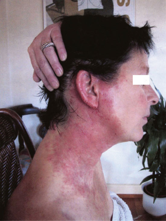 Figure 9.6 Allergic reaction reported after use of a hair colouring product
by a hairdresser
